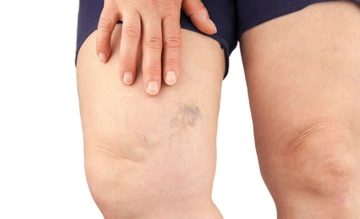 Varis Ameliyatı Sonrası